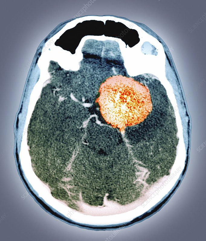 Brain Tumor Prediction