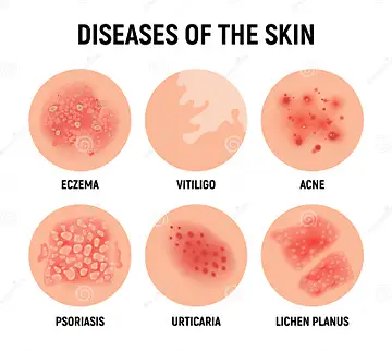 Skin Disease Prediction
